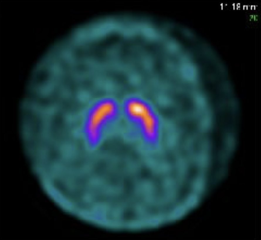 Dopamine.jpg displays an axial (top-down) view of a DaTscan, a type of SPECT imaging used to visualize dopamine transporter levels in the brain. In the center, two curved, comma-like shapes represent the striatum (composed of the caudate nucleus and putamen). The shape on the right side of the image, corresponding to the left hemisphere of the brain, shows normal radiotracer uptake with a distinct bright white and yellow ‘star’ indicating high dopamine activity in the head of the caudate. The shape on the left side of the image, corresponding to the right hemisphere, exhibits noticeably reduced uptake and lacks the bright white focal intensity. This asymmetric loss of signal, particularly the missing ‘star,’ visually demonstrates a deficit in dopaminergic nerve terminals, a key clinical indicator of early Parkinsonism.